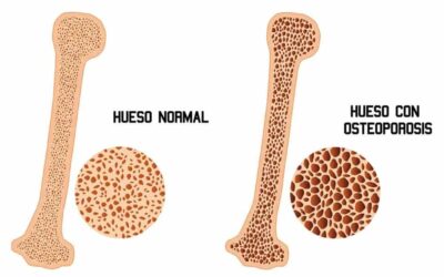 ¿Cómo ayuda la fisioterapia al tratamiento de la osteoporosis?